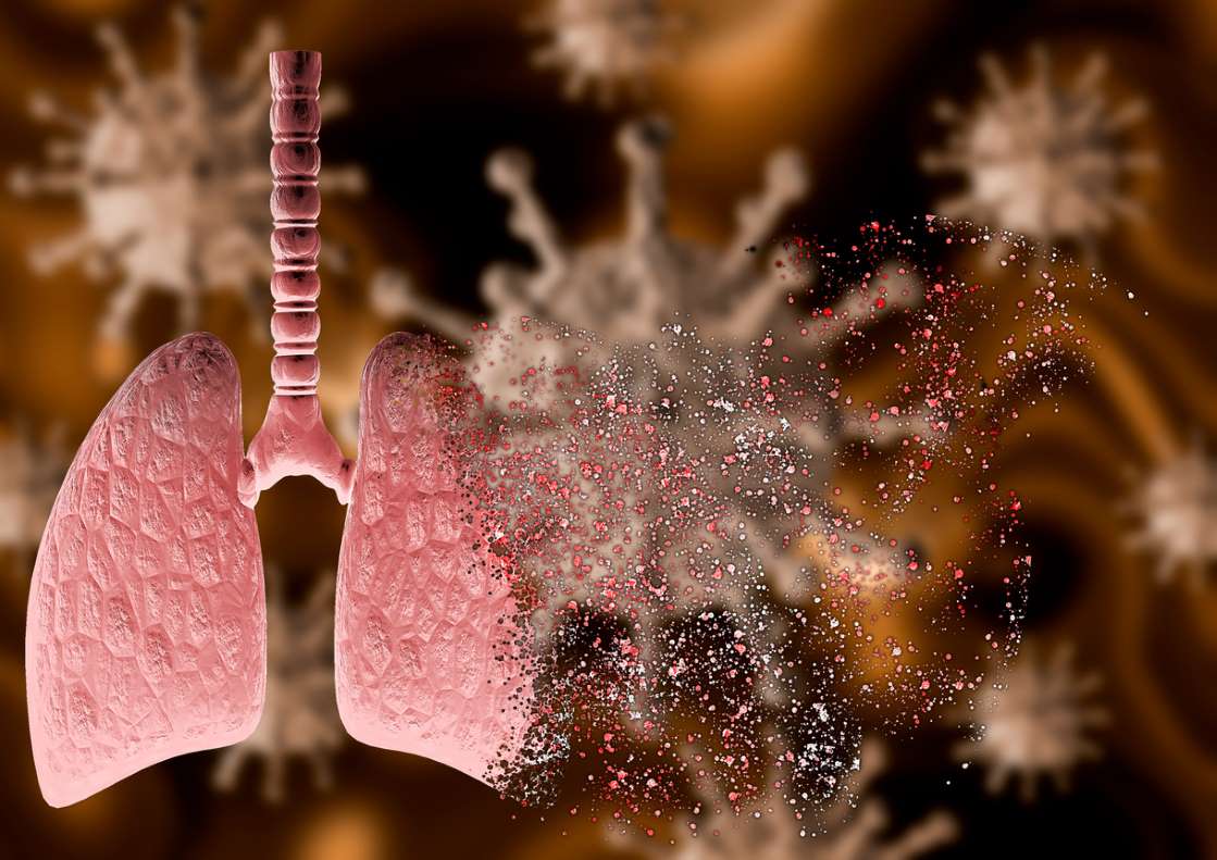 © Gilnature/istock coronavirus attacking lung with severe pneumonia disintegrating it, leading to death. 3D rendering
