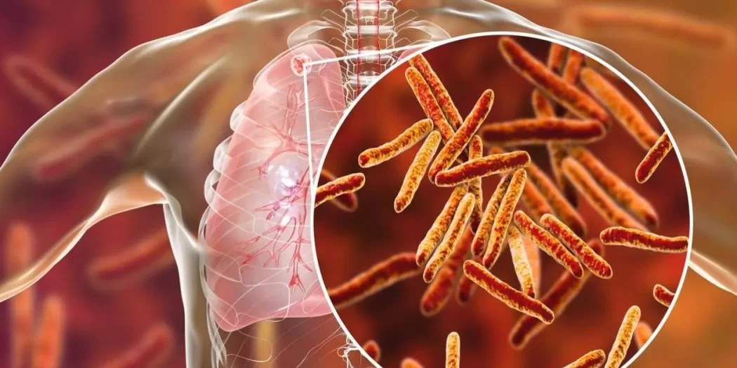 tuberculose-bacilo-de-koch-1588594669736_v2_1254x836-1050×525 tuberculose-bacilo-de-koch-1588594669736_v2_1254x836-1050x525