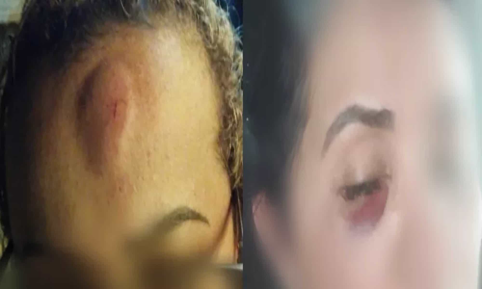 20 Professora ficou machucada na testa no dia do noivado; farmacêutica sofreu um hematoma no olho — Foto: Arquivo pessoal