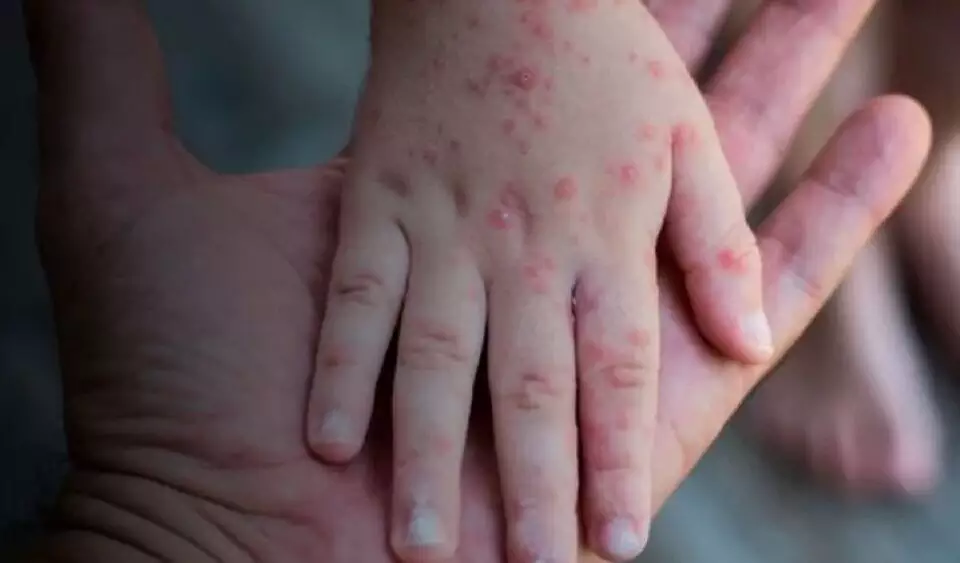 61a4cfad-variola-dos-macacos-crianca-960x563-1