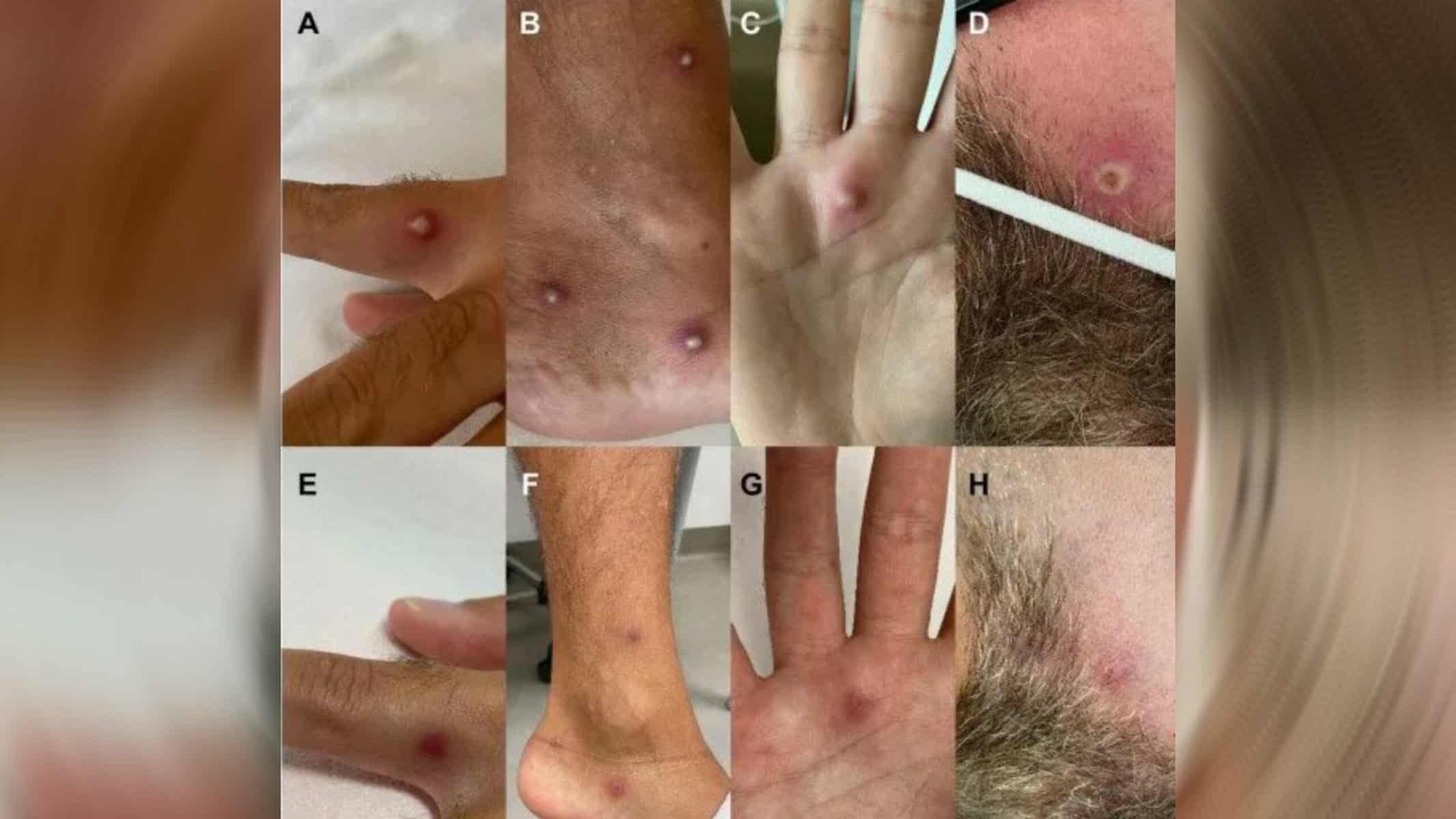Picsart_22-08-24_20-10-47-645 (Foto: Nolasco et al., 2022 / Journal of Infection)