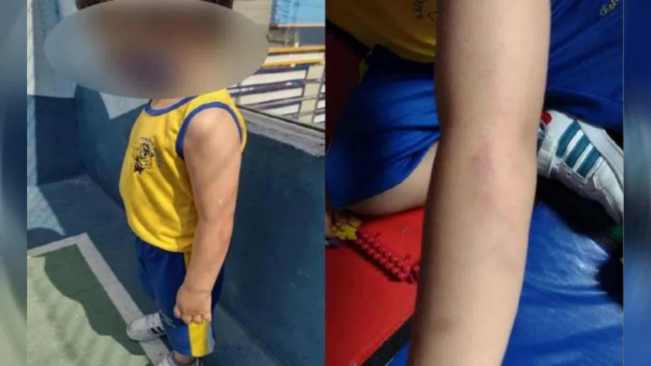 Picsart_22-08-30_20-47-43-694 Imagens mostram crianças com hematomas; Polícia apura suspeita de tortura contra crianças - Foto: Reprodução