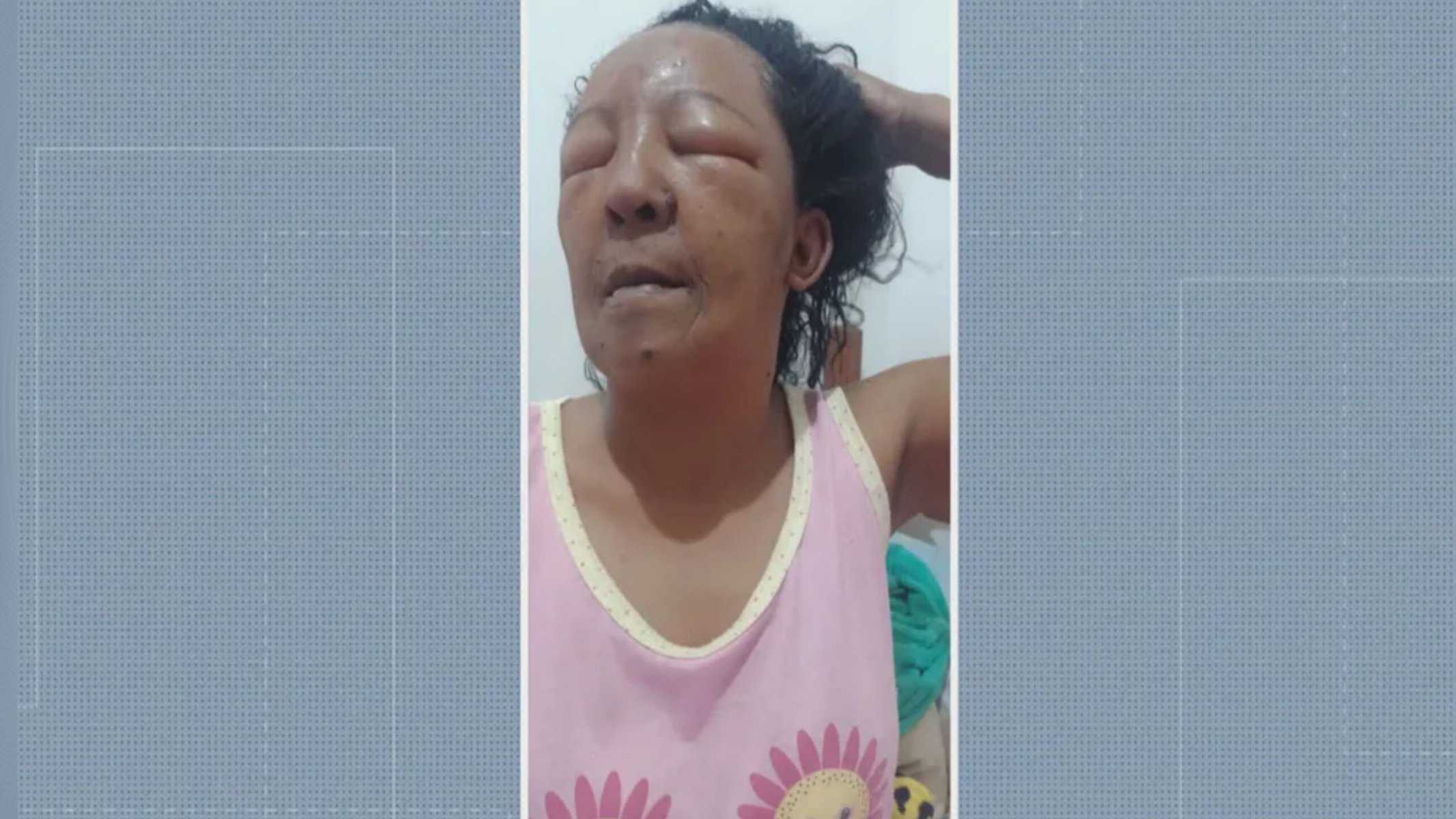 Alba Valéria fez relaxamento capilar e vai parar no hospital com inchaço nos olhos e lesões por todo o couro cabeludo — Foto: Reprodução/ TV Globo