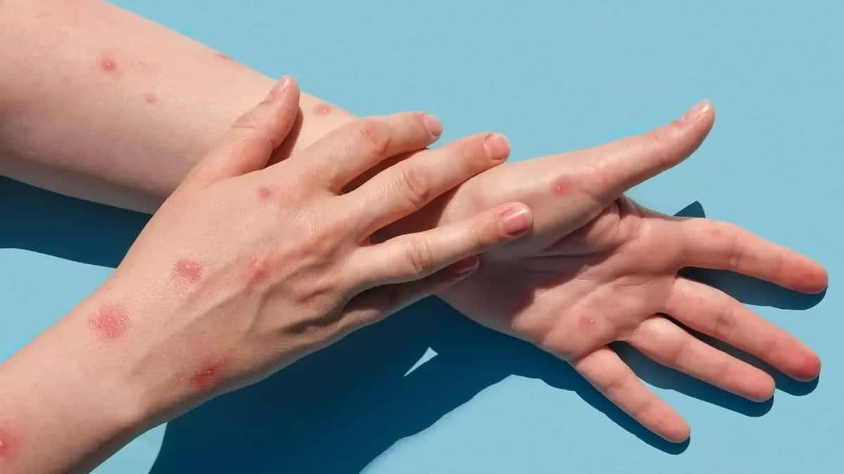 casos-da-variola-dos-macacos-se-distribuem-em-13-cidades-mineiras-55e46f94-96d6-465c-937a-bbc2d34f556a casos-da-variola-dos-macacos-se-distribuem-em-13-cidades-mineiras-55e46f94-96d6-465c-937a-bbc2d34f556a