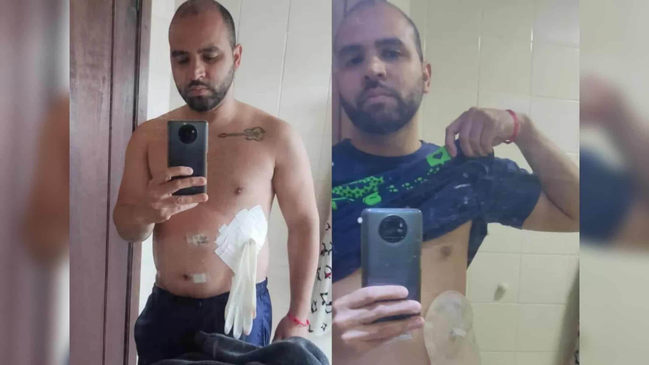 Médico é demitido após improvisar procedimento com luva cirúrgica no PR (Foto: arquivo pessoal)