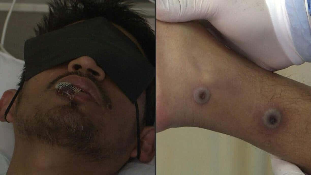 variola_dos_macacos__-21659274 variola_dos_macacos__-21659274