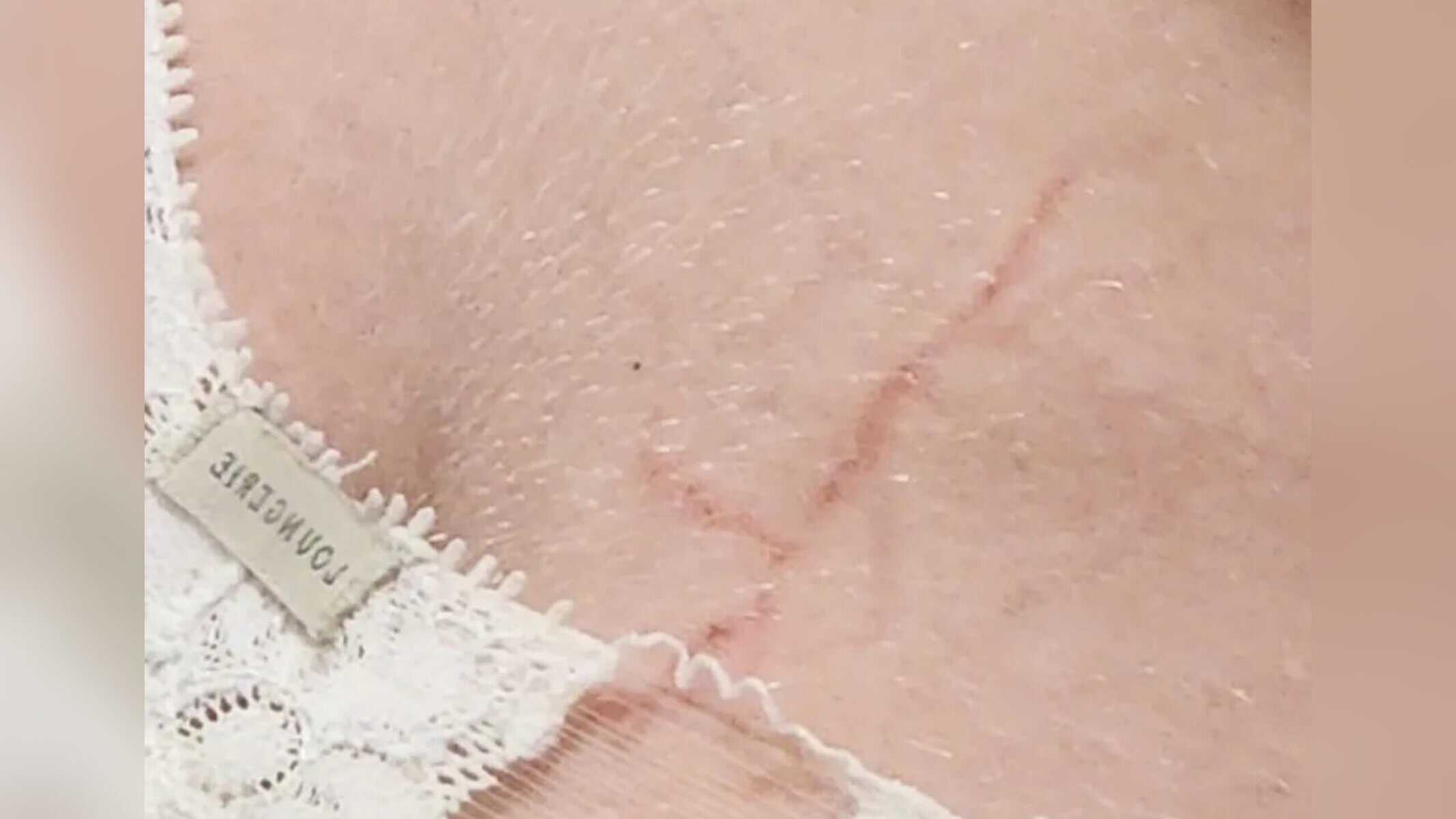 Picsart_22-11-02_20-07-19-340 Grávida é atingida por raio e fica com marca no corpo — Foto: Rafaela Parra/Arquivo Pessoal