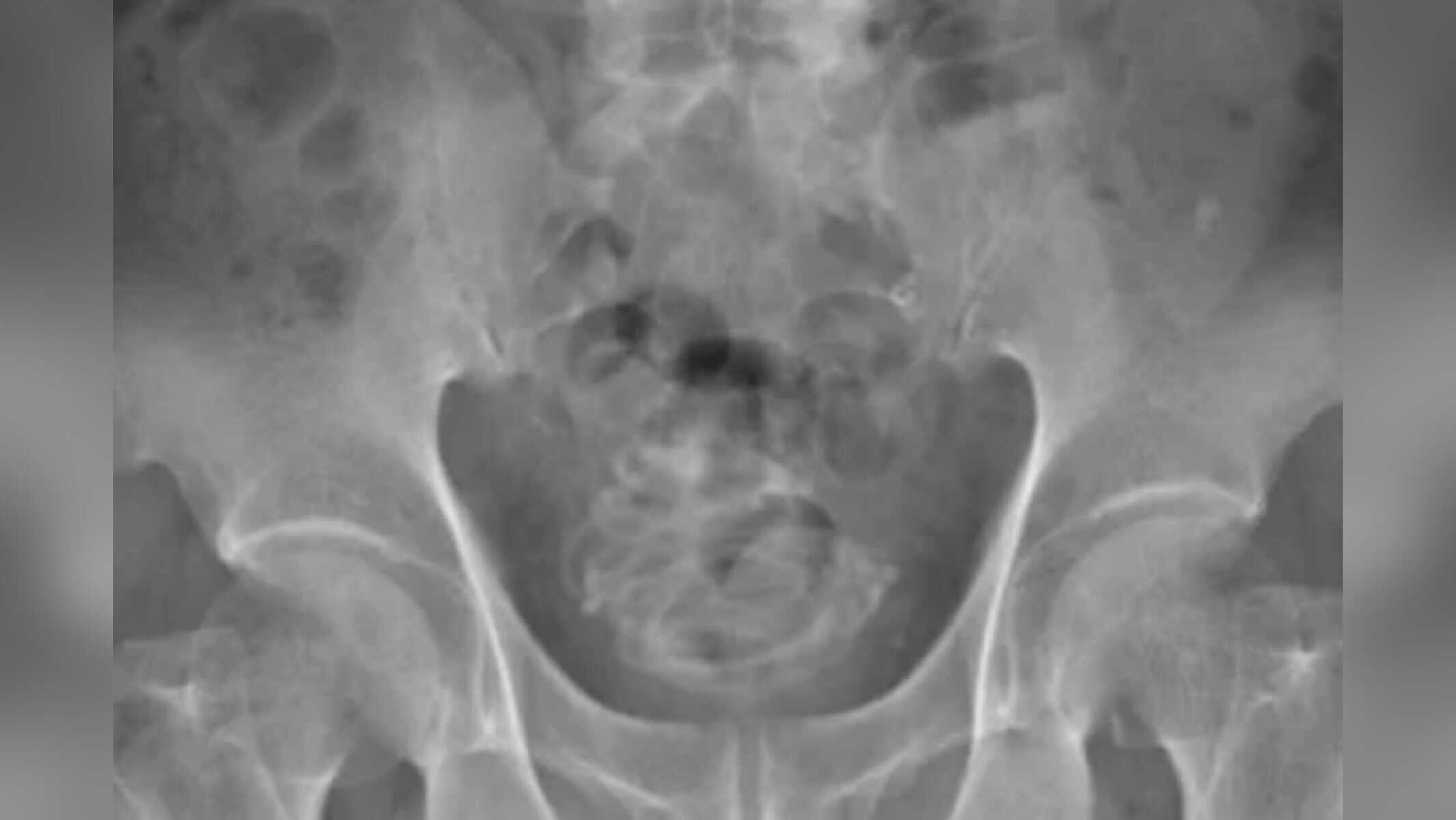 Reprodução/Urology Case Reports