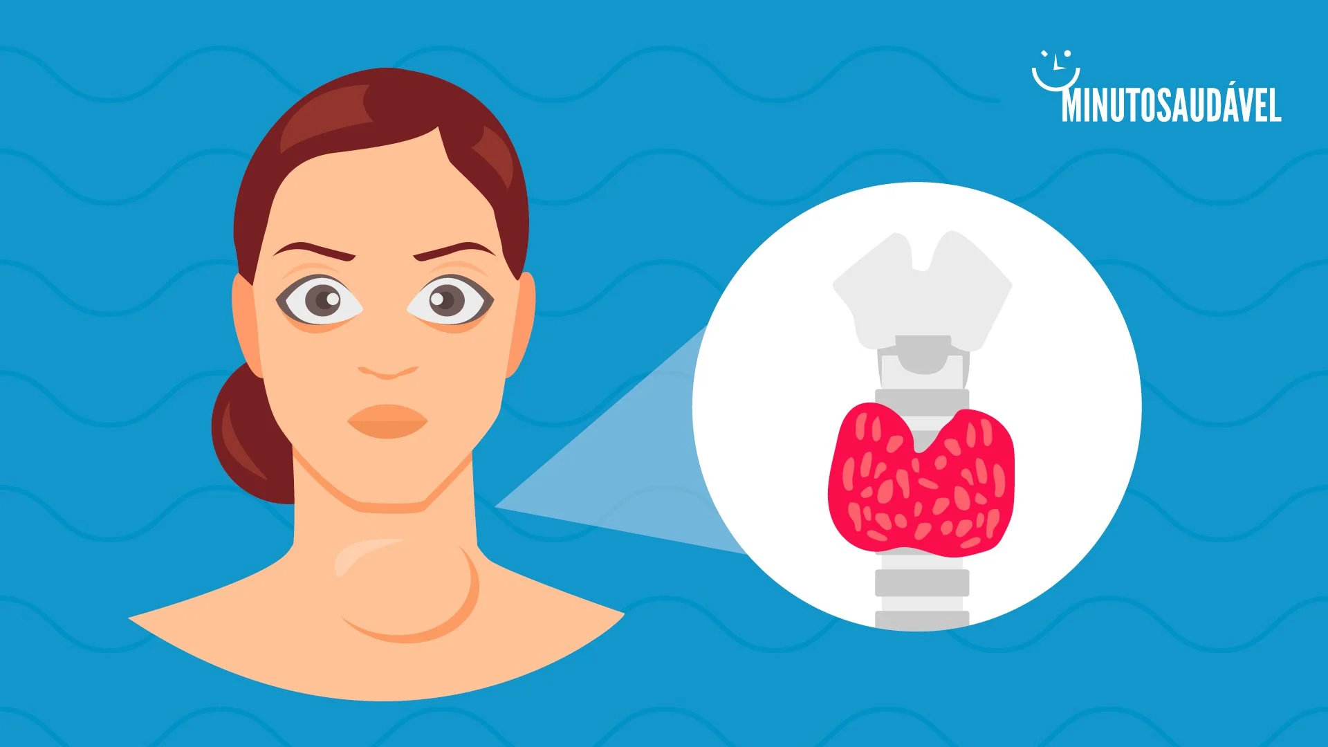 hipertireoidismo- hipertireoidismo-