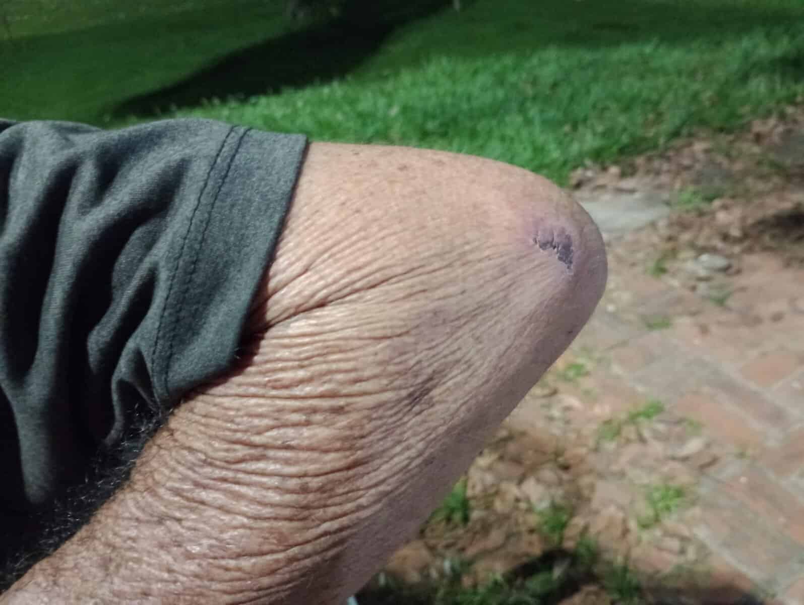 Buraco no arraial do bairro Tucumã causa transtornos após idosos caírem