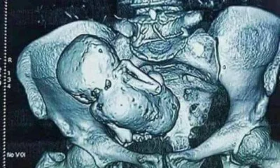 feto-calcificado-entenda feto-calcificado-entenda