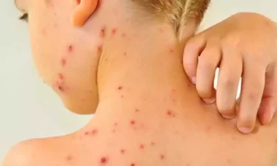 adolescente-sem-camisa-mostra-as-erupcoes-da-catapora_1_424591 (2) adolescente-sem-camisa-mostra-as-erupcoes-da-catapora_1_424591 (2)