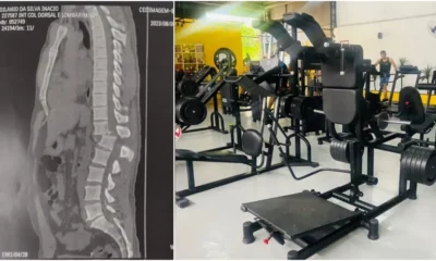 aparelho-maquina-coluna-raio-x aparelho-maquina-coluna-raio-x