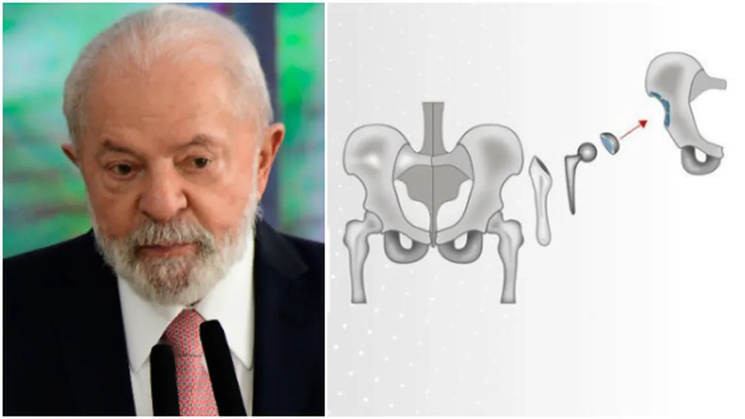 Lula fez sessões de fisioterapia e permanece ‘estável’, diz boletim