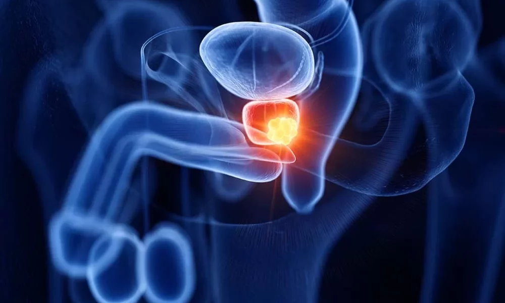 prevencao-do-cancer-de-prostata-confira-os-sintomas-jpg prevencao-do-cancer-de-prostata-confira-os-sintomas-jpg