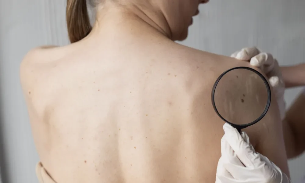 medica-diagnosticando-um-melanoma-no-corpo-de-uma-paciente-do-sexo-feminino