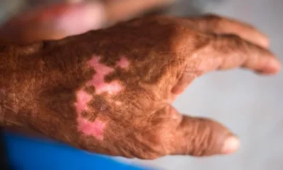 HANSENIASE_333jpg-jpg