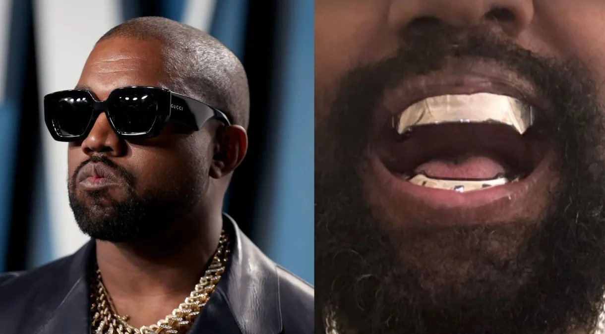 Kanye West coloca prótese de titânio na arcada dentária avaliada em R$ 4 milhões