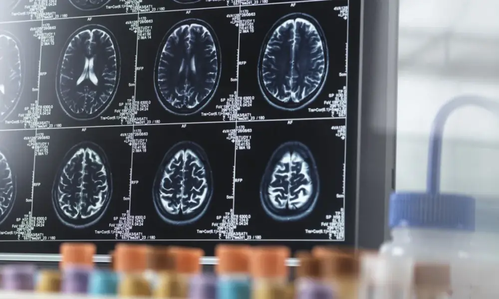 Pesquisadores listaram os fatores de risco genéticos e modificáveis que estão associados ao envelhecimento do cérebro
TEK IMAGE/SCIENCE PHOTO LIBRARY/GettyImages