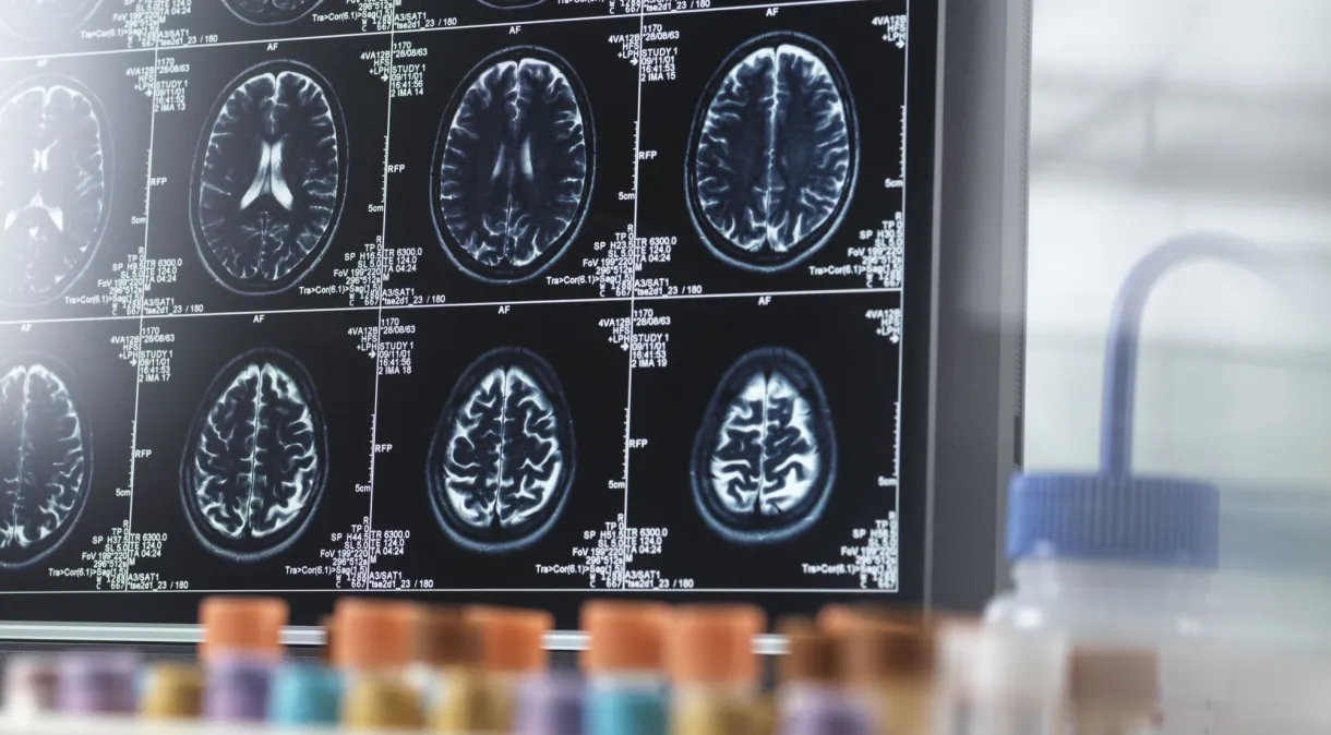 Estudo liga Covid, herpes e outras infecções virais ao risco de demência