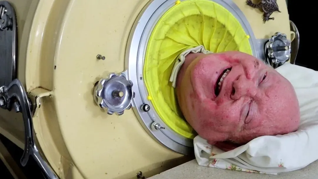 Morre Paul Alexander, o homem que viveu mais de 70 anos em “pulmão de ferro”