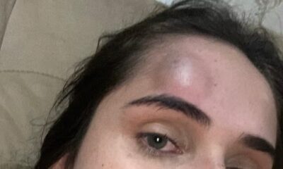 Palu Vitória mostra ferimento após levar coronhada na cabeça — Foto: Arquivo pessoal