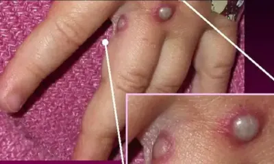 monkeypox-900×508 monkeypox-900x508