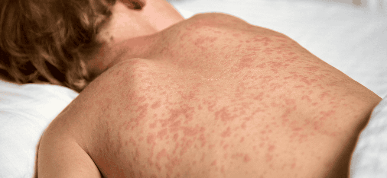 Acre está há 24 anos sem casos de sarampo, diz  Ministério da Saúde