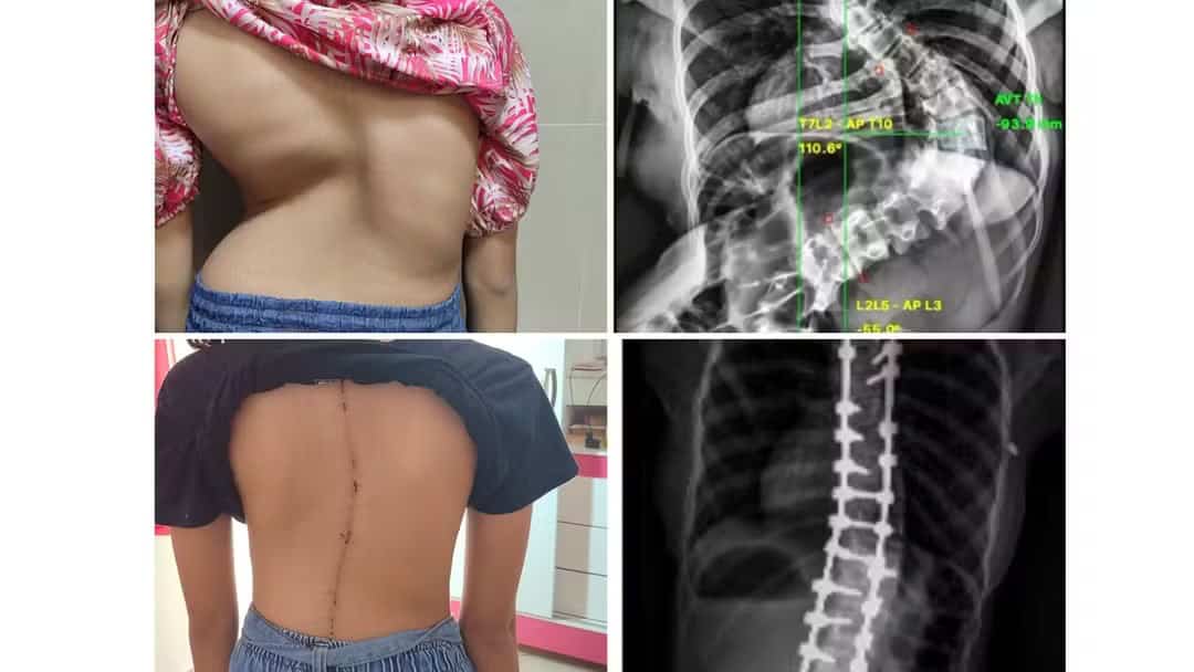 Adolescente com ‘coluna em S’ cresce 9 centímetros após cirurgia de correção