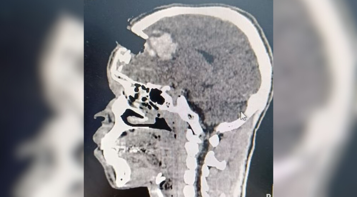 Homem tem crânio perfurado por pedaço de madeira durante obra no Rio de Janeiro