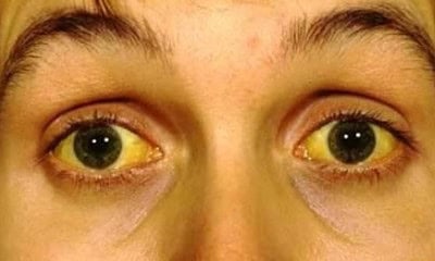 hepatite c pele amarelada ictericia 1396901698125 615x300 1 ok