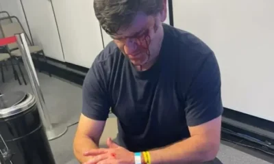 Duda Lima, marqueteiro de Ricardo Nunes (MDB), foi agredido e deixou o debate ensanguentado (Foto: Reprodução/Redes sociais)