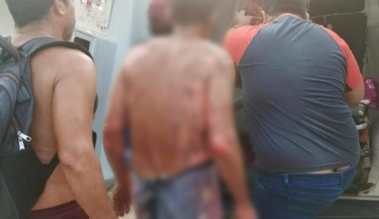Roçadeira explode e deixa homem com  corpo queimado no Acre