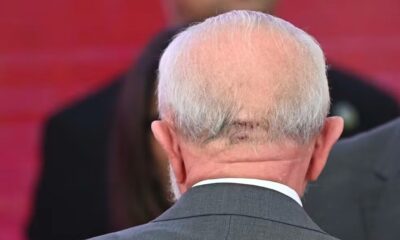 Com cicatriz na cabeça após sofrer um acidente doméstico, o presidente Luiz Inácio Lula da Silva participa de cerimônia no Palácio do Planalto, em Brasília, no dia 25 de outubro de 2024 — Foto: Ton Molina/Fotoarena/Estadão Conteúdo