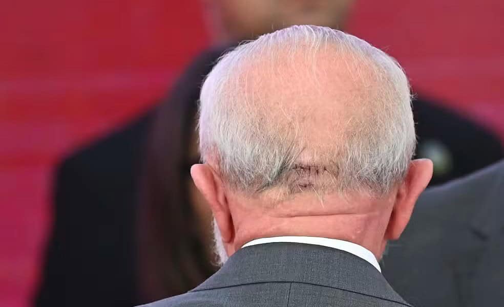 Com cicatriz na cabeça após sofrer um acidente doméstico, o presidente Luiz Inácio Lula da Silva participa de cerimônia no Palácio do Planalto, em Brasília, no dia 25 de outubro de 2024 — Foto: Ton Molina/Fotoarena/Estadão Conteúdo