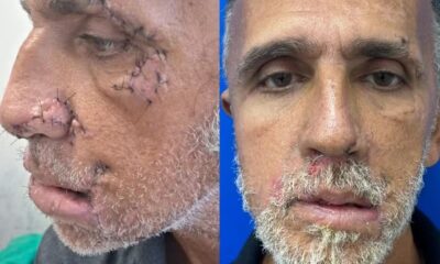 Catador sobrevive após ser atacado por dois pitbulls na Baixada Fluminense — Foto: Divulgação