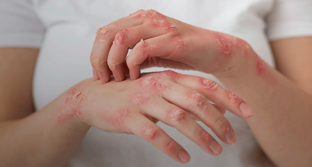 lupus-blog-1024×536 lupus-blog-1024x536