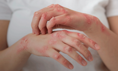lupus-blog-1024×536 lupus-blog-1024x536