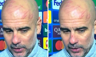 pep-guardiola-machucado
