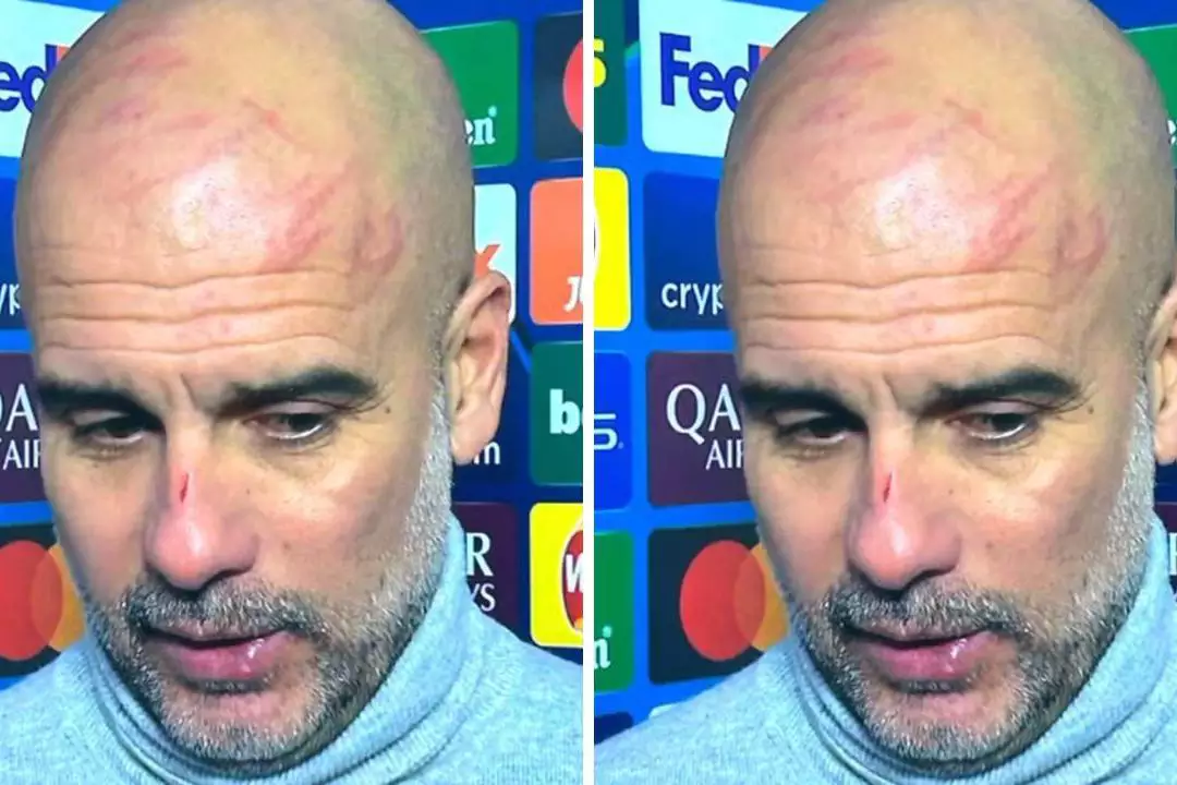 Guardiola esclarece fala sobre machucados no rosto e alerta para saúde mental