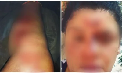 Ferimentos da vítima • Reprodução