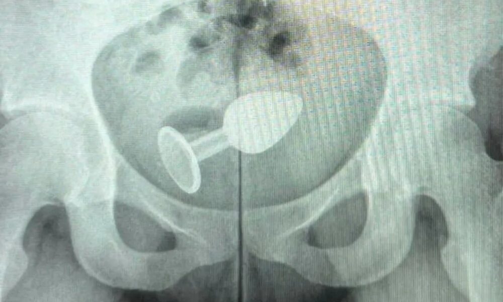 Sex toy foi parar no reto da paciente — Foto: Arquivo Pessoal