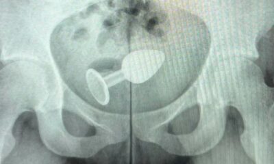 Sex toy foi parar no reto da paciente — Foto: Arquivo Pessoal