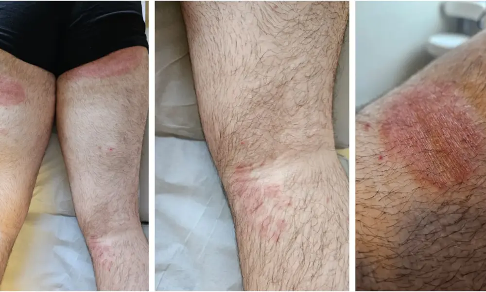 Aspecto-clinico-das-lesoes-de-dermatofitose-causadas-por-Trichophyton-indotineae_Reproducao-revista-Anais-Brasileiros-de-Dermatologia Aspecto clínico das lesões de dermatofitose causadas por Trichophyton indotineae (Imagem: Reprodução/Revista Anais Brasileiros de Dermatologia)