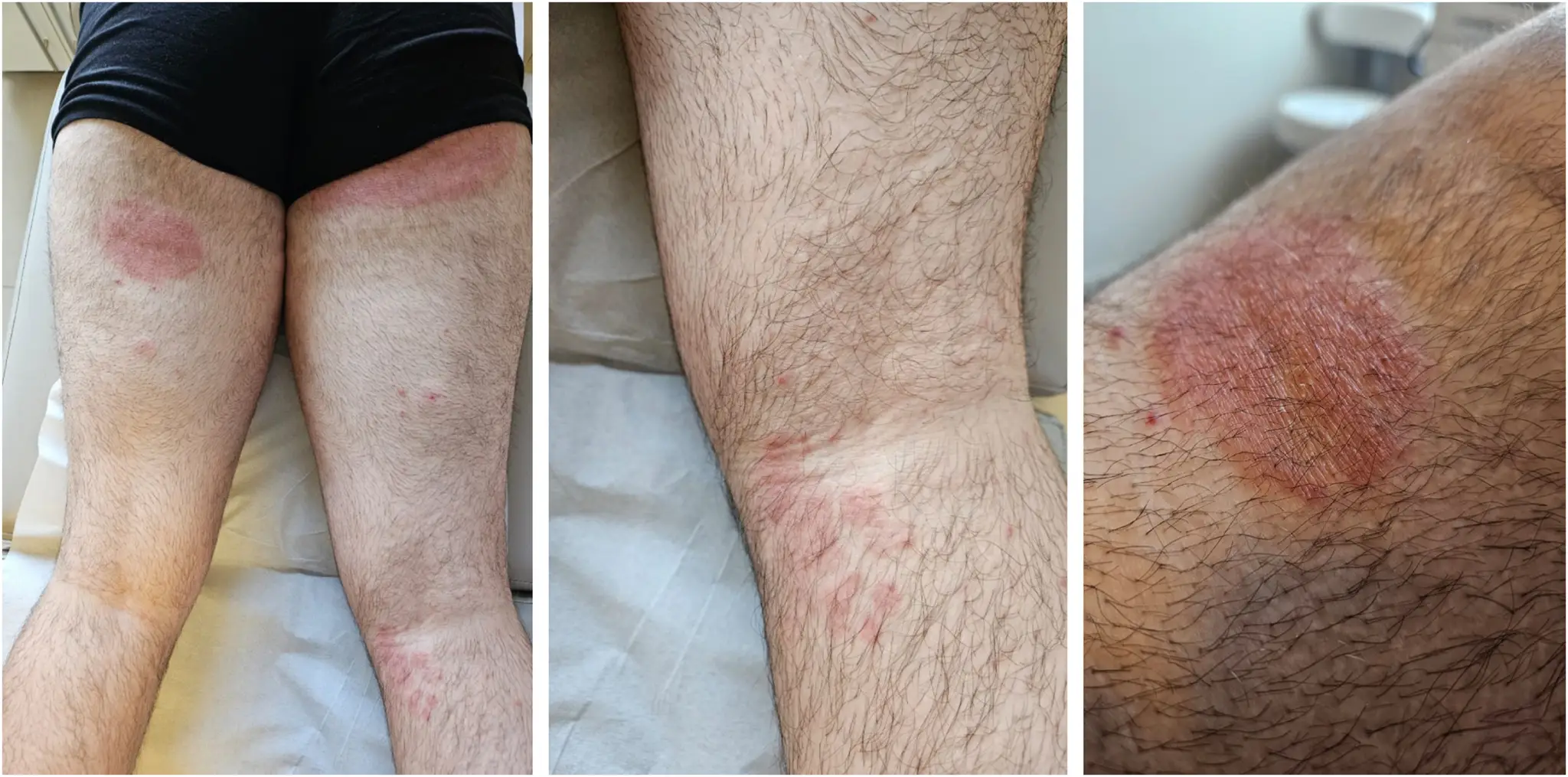 Brasil registra primeiro caso de ‘super fungo’ resistente que causa micose extensa