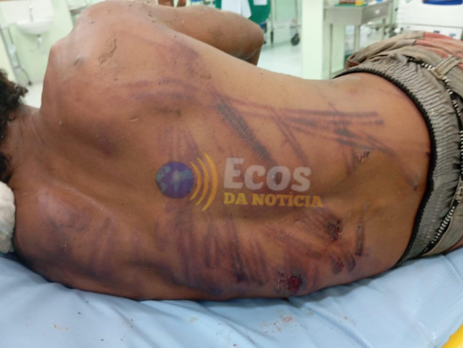 Homem é açoitado com fio elétrico por membros de organização criminosa em Rio Branco e vai parar no Pronto-Socorro