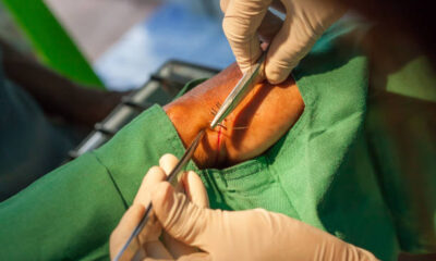 Method bind thread while suturing wound